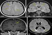 Evaluation Of Brain And Cervical Mri Abnormality Rates In Patients With Systemic Lupus Erythematosus With Or Without Neurological Manifestations